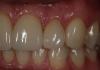 Tooth #10, CEREC® Veneer