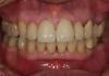 Anterior Case After - Upper and lower veneers