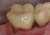 Molar Crown Final